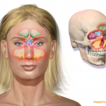 Sinusitis image womans face "Blausen 0800 Sinusitis" by BruceBlaus - Own work. Licensed under Creative Commons Attribution 3.0 via Wikimedia Commons